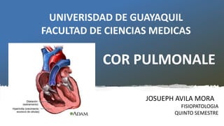 UNIVERISDAD DE GUAYAQUIL
FACULTAD DE CIENCIAS MEDICAS
JOSUEPH AVILA MORA
FISIOPATOLOGIA
QUINTO SEMESTRE
COR PULMONALE
 