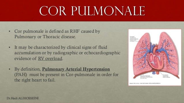 Definition Of Cor Pulmonale Cor pulmonale