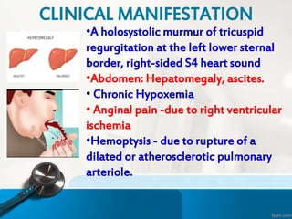 •A holosystolic murmur of tricuspid
regurgitation at the left lower sternal
border, right-sided S4 heart sound
•Abdomen: Hepatomegaly, ascites.
• Chronic Hypoxemia
• Anginal pain -due to right ventricular
ischemia
•Hemoptysis - due to rupture of a
dilated or atherosclerotic pulmonary
arteriole.
CLINICAL MANIFESTATION
 