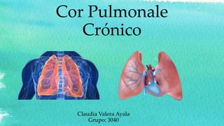 Cor Pulmonale
Crónico
Claudia Valera Ayala
Grupo: 3040
 
