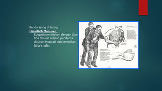Benda asing di laring:
Heimlich Manuver :
Epigastrum ditekan dengan tiba-
tiba & kuat setelah penderita
disuruh inspirasi dan kemudian
tahan nafas
 