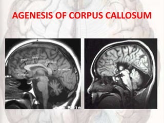 AGENESIS OF CORPUS CALLOSUM
 
