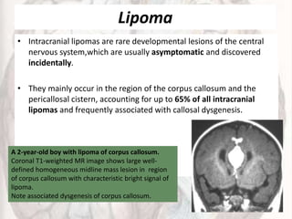 Lipoma
• Intracranial lipomas are rare developmental lesions of the central
nervous system,which are usually asymptomatic and discovered
incidentally.
• They mainly occur in the region of the corpus callosum and the
pericallosal cistern, accounting for up to 65% of all intracranial
lipomas and frequently associated with callosal dysgenesis.
A 2-year-old boy with lipoma of corpus callosum.
Coronal T1-weighted MR image shows large well-
defined homogeneous midline mass lesion in region
of corpus callosum with characteristic bright signal of
lipoma.
Note associated dysgenesis of corpus callosum.
 