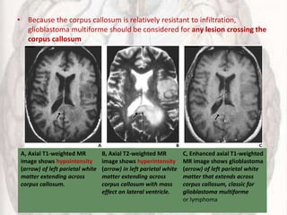 • Because the corpus callosum is relatively resistant to infiltration,
glioblastoma multiforme should be considered for any lesion crossing the
corpus callosum
A, Axial T1-weighted MR
image shows hypointensity
(arrow) of left parietal white
matter extending across
corpus callosum.
B, Axial T2-weighted MR
image shows hyperintensity
(arrow) in left parietal white
matter extending across
corpus callosum with mass
effect on lateral ventricle.
C, Enhanced axial T1-weighted
MR image shows glioblastoma
(arrow) of left parietal white
matter that extends across
corpus callosum, classic for
glioblastoma multiforme
or lymphoma
 