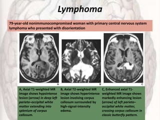 Lymphoma
A, Axial T1-weighted MR
image shows hypointense
lesion (arrow) in deep left
parieto–occipital white
matter extending into
splenium of corpus
callosum.
B, Axial T2-weighted MR
image shows hyperintense
lesion involving corpus
callosum surrounded by
high-signal-intensity
edema.
C, Enhanced axial T1-
weighted MR image shows
markedly enhancing lesion
(arrow) of left parieto–
occipital white matter,
crossing corpus callosum in
classic butterfly pattern.
79-year-old nonimmunocompromised woman with primary central nervous system
lymphoma who presented with disorientation
 
