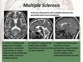 Multiple Sclerosis
A, Axial T2-weighted MR
image shows multiple
hyperintense somewhat
ovoid lesions of corpus
callosum and periventricular
white matter, classic for
multiple sclerosis.
B, Sagittal T2-weighted MR
image shows multiple
hyperintense lesions (arrows)
in corpus callosum.
C, Sagittal fluid-attenuated
inversion recovery
paramedian image obtained
through corpus callosum
shows multiple ovoid
hyperintense lesions (arrow).
A 24-year-old woman with multiple sclerosis who
presented with visual complaints.
 