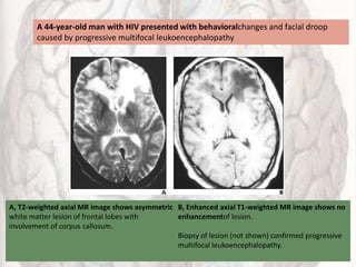 A, T2-weighted axial MR image shows asymmetric
white matter lesion of frontal lobes with
involvement of corpus callosum.
B, Enhanced axial T1-weighted MR image shows no
enhancementof lesion.
Biopsy of lesion (not shown) confirmed progressive
multifocal leukoencephalopathy.
A 44-year-old man with HIV presented with behavioralchanges and facial droop
caused by progressive multifocal leukoencephalopathy
 