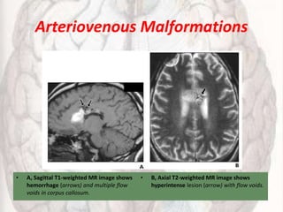 Arteriovenous Malformations
• A, Sagittal T1-weighted MR image shows
hemorrhage (arrows) and multiple flow
voids in corpus callosum.
• B, Axial T2-weighted MR image shows
hyperintense lesion (arrow) with flow voids.
 