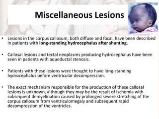 Miscellaneous Lesions
• Lesions in the corpus callosum, both diffuse and focal, have been described
in patients with long-standing hydrocephalus after shunting.
• Callosal lesions and tectal neoplasms producing hydrocephalus have been
seen in patients with aqueductal stenosis.
• Patients with these lesions were thought to have long-standing
hydrocephalus before ventricular decompression.
• The exact mechanism responsible for the production of these callosal
lesions is unknown, although they may be the result of ischemia with
subsequent demyelination caused by prolonged severe stretching of the
corpus callosum from ventriculomegaly and subsequent rapid
decompression of the ventricles.
 
