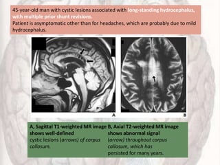 45-year-old man with cystic lesions associated with long-standing hydrocephalus,
with multiple prior shunt revisions.
Patient is asymptomatic other than for headaches, which are probably due to mild
hydrocephalus.
A, Sagittal T1-weighted MR image
shows well-defined
cystic lesions (arrows) of corpus
callosum.
B, Axial T2-weighted MR image
shows abnormal signal
(arrow) throughout corpus
callosum, which has
persisted for many years.
 
