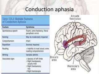 Conduction aphasia
 