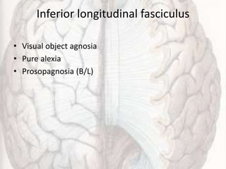 Inferior longitudinal fasciculus
• Visual object agnosia
• Pure alexia
• Prosopagnosia (B/L)
 