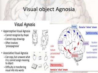 Visual object Agnosia
 