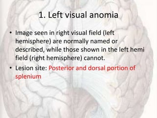 1. Left visual anomia
• Image seen in right visual field (left
hemisphere) are normally named or
described, while those shown in the left hemi
field (right hemisphere) cannot.
• Lesion site: Posterior and dorsal portion of
splenium
 