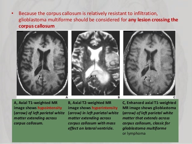 Corpus callosum with disconnection syndromes