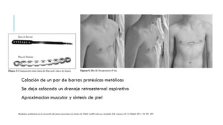 CORRECCIÓN DE PECTUS EXCAVATUM 22.07.24.pptx