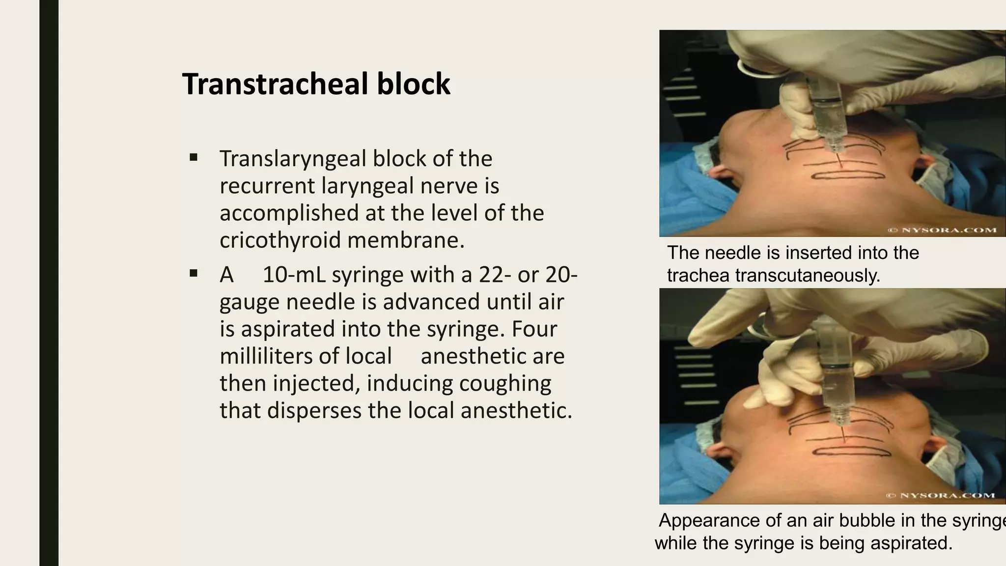 Transcutaneously Anesthesia For Dental surgery | PPTX
