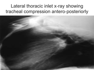 Lateral thoracic inlet x‐ray showing
tracheal compression antero‐posteriorly
 