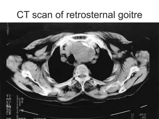 CT scan of retrosternal goitre
 