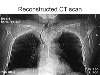 Reconstructed CT scan
 