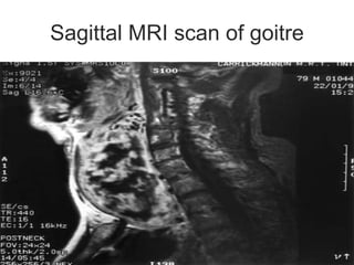Sagittal MRI scan of goitre
 