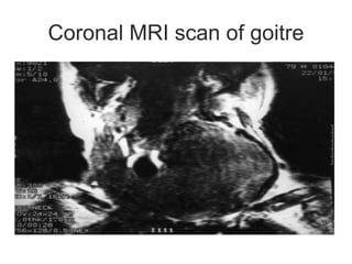 Coronal MRI scan of goitre
 