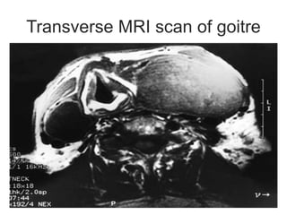 Transverse MRI scan of goitre
 