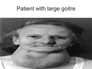 Patient with large goitre
 