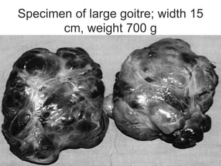 Specimen of large goitre; width 15
cm, weight 700 g
 