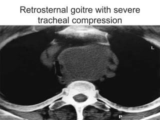 Retrosternal goitre with severe
tracheal compression
 