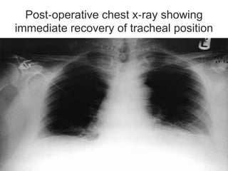 Post‐operative chest x‐ray showing
immediate recovery of tracheal position
 
