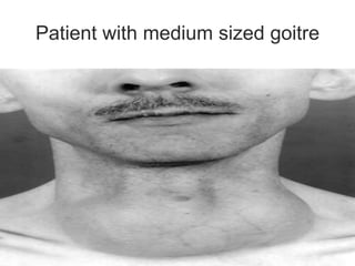 Patient with medium sized goitre
 