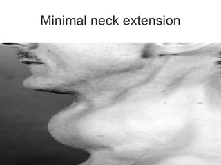 Minimal neck extension
 