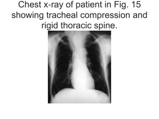 Chest x‐ray of patient in Fig. 15
showing tracheal compression and
rigid thoracic spine.
 
