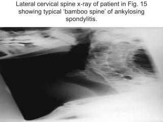 Lateral cervical spine x‐ray of patient in Fig. 15
showing typical ‘bamboo spine’ of ankylosing
spondylitis.
 