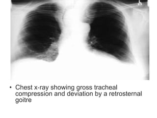 • Chest x‐ray showing gross tracheal
compression and deviation by a retrosternal
goitre
 