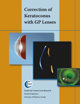 Correction of
Keratoconus
with GP Lenses
Centre for Contact Lens Research
School of Optometry
University of Waterloo, Canada
 