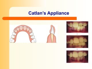 corrective orthodontics ug lecture .pptx
