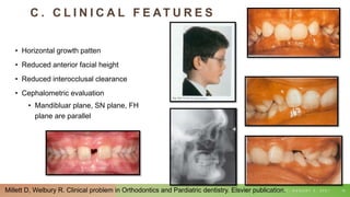 C . C L I N I C A L F E AT U R E S
• Horizontal growth patten
• Reduced anterior facial height
• Reduced interocclusal clearance
• Cephalometric evaluation
• Mandibluar plane, SN plane, FH
plane are parallel
T U E S D A Y , A U G U S T 3 , 2 0 2 1 13
Millett D, Welbury R. Clinical problem in Orthodontics and Pardiatric dentistry. Elsvier publication.
 
