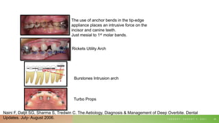 T U E S D A Y , A U G U S T 3 , 2 0 2 1 26
The use of anchor bends in the tip-edge
appliance places an intrusive force on the
incisor and canine teeth.
Just mesial to 1st molar bands.
Rickets Utility Arch
Burstones Intrusion arch
Turbo Props
Naini F, Daljit SG, Sharma S, Tredwin C. The Aetiology, Diagnosis & Management of Deep Overbite. Dental
Updates. July- August 2006.
 
