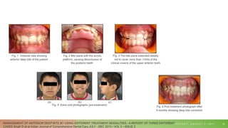 T U E S D A Y , A U G U S T 3 , 2 0 2 1 29
MANAGEMENT OF ANTERIOR DEEP BITE BY USING DIFFERENT TREATMENT MODALITIES - A REPORT OF THREE DIFFERENT
CASES Singh D et al Indian Journal of Comprehensive Dental Care JULY - DEC 2013 • VOL 3 • ISSUE 2
 