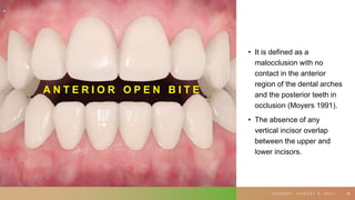 • It is defined as a
malocclusion with no
contact in the anterior
region of the dental arches
and the posterior teeth in
occlusion (Moyers 1991).
• The absence of any
vertical incisor overlap
between the upper and
lower incisors.
T U E S D A Y , A U G U S T 3 , 2 0 2 1 36
A N T E R I O R O P E N B I T E
 