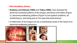 • Non-hereditary factors
• Subtelny and Sakuda (1964) and Tulley (1969), have stressed the
abnormal functional patterns of the tongue, pernicious oral habits (Figure
3), abnormal swallowing patterns (Figure 4) and speech problems, all
contributing to, and being part of, the open-bite phenomenon.
• A malfunction of the tongue can be a contributing cause or the result of an
abnormal swallowing behaviour.
T U E S D A Y , A U G U S T 3 , 2 0 2 1 42
 