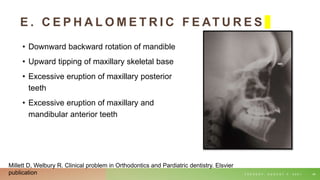 E . C E P H A L O M E T R I C F E AT U R E S
• Downward backward rotation of mandible
• Upward tipping of maxillary skeletal base
• Excessive eruption of maxillary posterior
teeth
• Excessive eruption of maxillary and
mandibular anterior teeth
T U E S D A Y , A U G U S T 3 , 2 0 2 1 48
Millett D, Welbury R. Clinical problem in Orthodontics and Pardiatric dentistry. Elsvier
publication
 