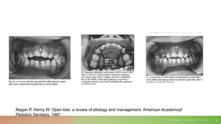 T U E S D A Y , A U G U S T 3 , 2 0 2 1 52
Nagan P, Henry W. Open bite: a review of etiology and management. American Academoyf
Pediatric Dentistry. 1997
 