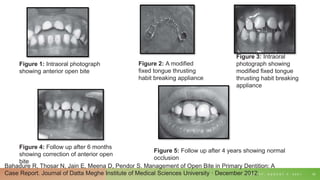 T U E S D A Y , A U G U S T 3 , 2 0 2 1 53
Bahadure R, Thosar N, Jain E, Meena D, Pendor S. Management of Open Bite in Primary Dentition: A
Case Report. Journal of Datta Meghe Institute of Medical Sciences University · December 2012.
Figure 1: Intraoral photograph
showing anterior open bite
Figure 2: A modified
fixed tongue thrusting
habit breaking appliance
Figure 3: Intraoral
photograph showing
modified fixed tongue
thrusting habit breaking
appliance
Figure 4: Follow up after 6 months
showing correction of anterior open
bite
Figure 5: Follow up after 4 years showing normal
occlusion
 