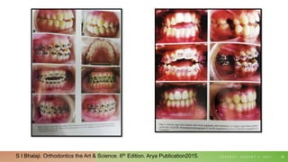 T U E S D A Y , A U G U S T 3 , 2 0 2 1 66
S I Bhalaji. Orthodontics the Art & Science. 6th Edition. Arya Publication2015.
 