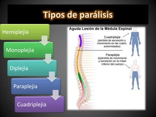 Hemiplejia
Monoplejia
Diplejía
Paraplejia
Cuadriplejia
 