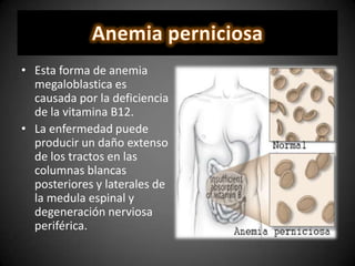 • Esta forma de anemia
megaloblastica es
causada por la deficiencia
de la vitamina B12.
• La enfermedad puede
producir un daño extenso
de los tractos en las
columnas blancas
posteriores y laterales de
la medula espinal y
degeneración nerviosa
periférica.
 