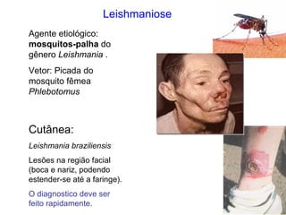 Leishmaniose
Agente etiológico:
mosquitos-palha do
gênero Leishmania .
Vetor: Picada do
mosquito fêmea
Phlebotomus
Cutânea:
Leishmania braziliensis
Lesões na região facial
(boca e nariz, podendo
estender-se até a faringe).
O diagnostico deve ser
feito rapidamente.
 